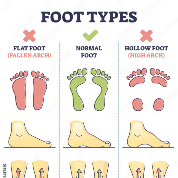 Hollow Feet Mastery: Uncover Ultimate Solutions for High Arch Challenges – A Holistic Guide