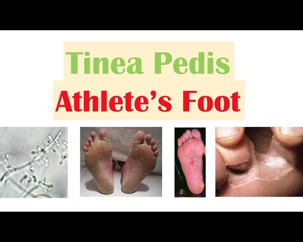 Effective Foot Care Guide for Athlete’s Foot