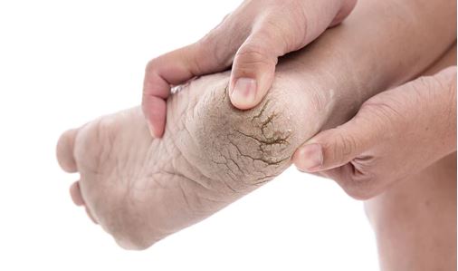 Unraveling Cracked Heels: Causes, Prevention, and Solutions