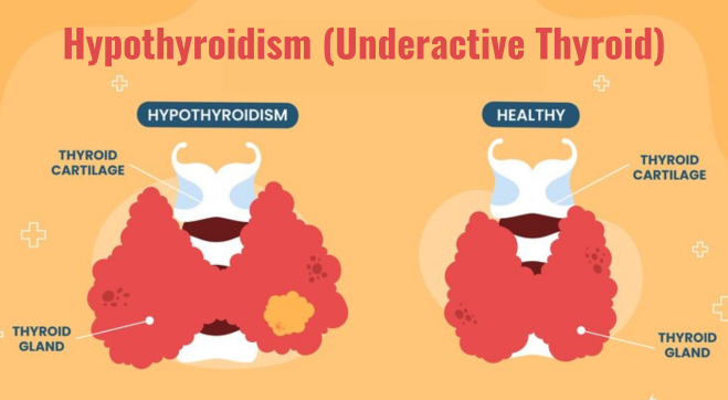 Hypothyroidism unreactive thyroid
