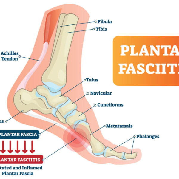 Revolutionize Your Recovery: Natural Remedies for Plantar Fasciitis – Fresh Home Keepers