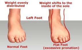 Flat Feet Mastery: Unveil Transformative Solutions for Ultimate Comfort