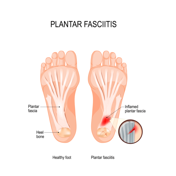 Exercises for Plantar Fasciitis Relief: Unveil Proven Exercises for Soothing Comfort