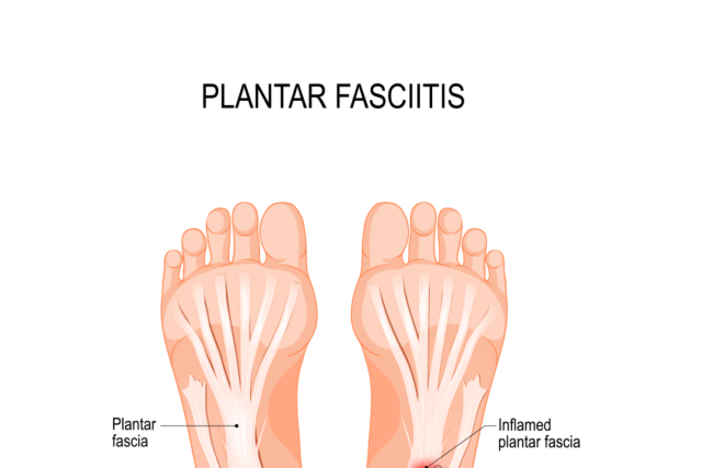 Exercises for Plantar Fasciitis Relief: Unveil Proven Exercises for Soothing Comfort