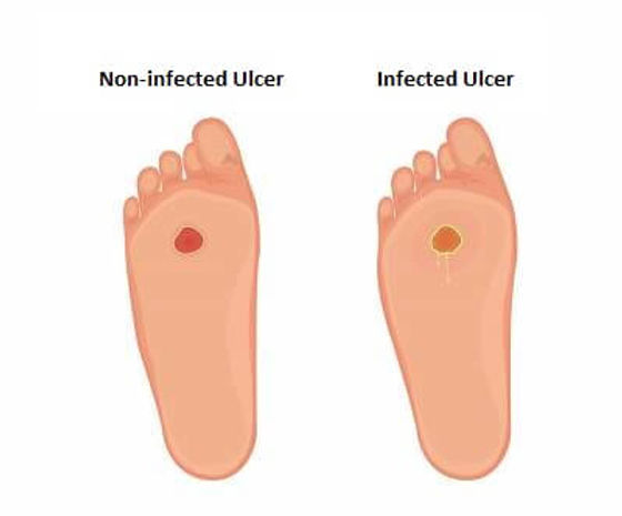 Revitalize Your Feet: Unveiling the Secrets to Foot Ulcers Prevention & Natural Healing