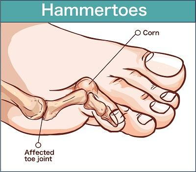 Unlock Relief: Essential Guide to Hammertoes Causes, Symptoms, and Treatments