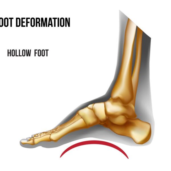 Revolutionize Your Hollow Feet Management: Proven Exercises for Enhanced Strength and Flexibility