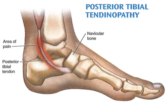 Posterior Tibial Tendon Dysfunction Unlocked: Innovative Healing Strategies