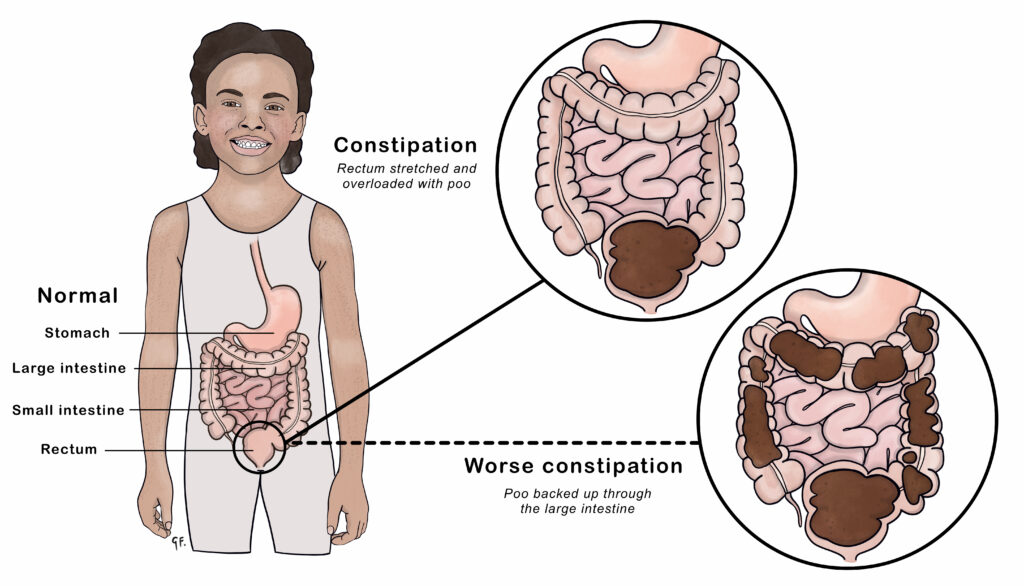 Taboo of Constipation