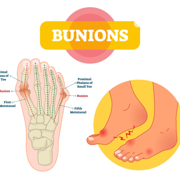 Unlock Relief: Effective Bunions Solutions for Pain-Free Feet