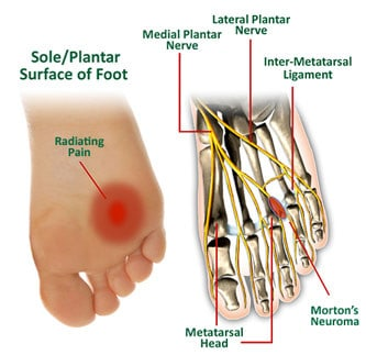 Morton’s Neuroma Mastery: Unveil Healing Strategies & Empower Your Steps for Ultimate Foot Health