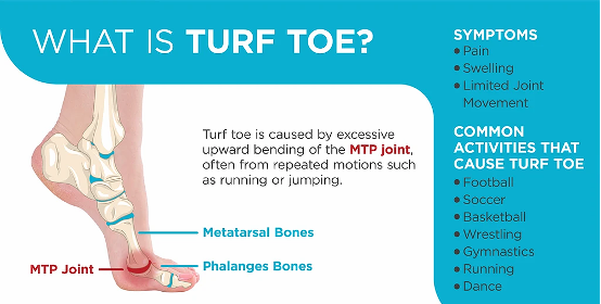 Turf Toes Mastery: Ultimate Guide to Swift Recovery and Prevention