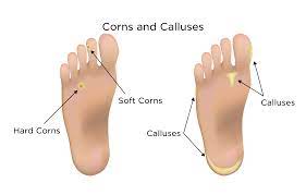 Callus and Corn Prevention: Unlock Innovative Foot Comfort Solutions