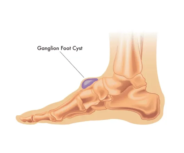 Ganglion Cysts Demystified: Breakthrough Treatments and Essential Insights