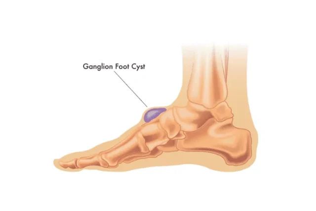 Ganglion Cysts Demystified: Breakthrough Treatments and Essential Insights