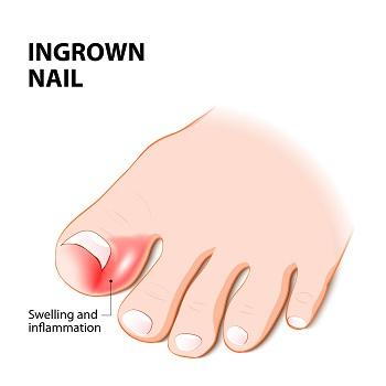 Ingrown Toenails Decoded: Ultimate Relief Strategies for Pain-Free Feet