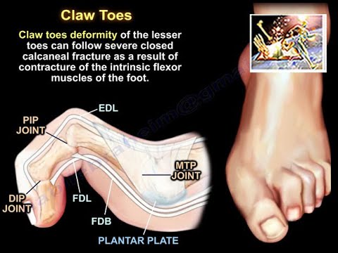 Claw Toes Unraveled: Revolutionary Insights and Empowering Solutions