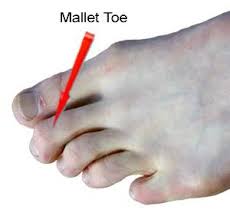 Mallet Toes Explained: Uncover Effective Prevention and Management Strategies