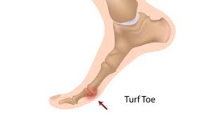 Turf Toes