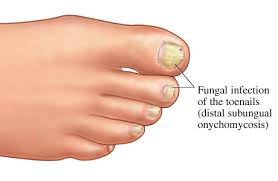 Fungal Nail Infections Uncovered: Essential Insights, Effective Remedies & Prevention Tips