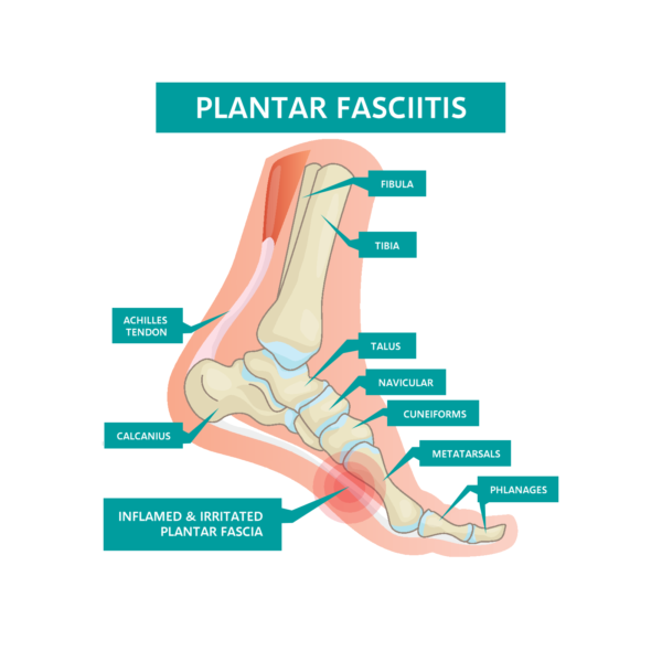 Uncover the Best Plantar Fasciitis Insoles of Today: Experience Unmatched Comfort