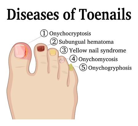 Yellow Nail Syndrome Unveiled: Discover Revolutionary Treatments and Insights