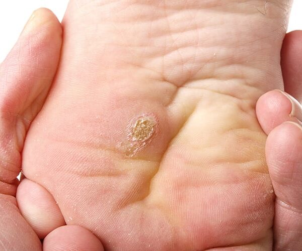 Warts Demystified: Empowering Insights, Proven Solutions & Holistic Care