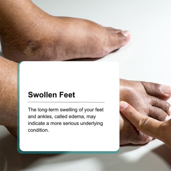 Swollen Feet Relief: Unlock Proven Soothing Strategies