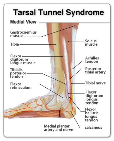 Unlocking Relief: Tarsal Tunnel Syndrome – Revolutionary Treatments & Insights